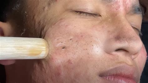 As the filmer, Le Thin, squeezes the patient's face, the gunk keeps coming. . Huong acne videos
